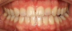 Close-up of teeth before treatment in Phoenix, AZ | 24th Street Dental Biltmore