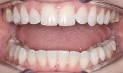 Close-up of teeth after treatment in Phoenix, AZ | 24th Street Dental Biltmore