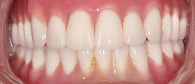 Close-up of teeth before treatment in Phoenix, AZ | 24th Street Dental Biltmore