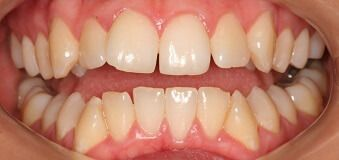 Close-up of teeth before treatment in Phoenix, AZ | 24th Street Dental Biltmore