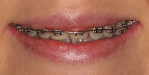 Close-up of teeth before metal braces in Phoenix, AZ | 24th Street Dental Biltmore