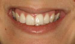 Close-up of teeth after treatment in Phoenix, AZ | 24th Street Dental Biltmore