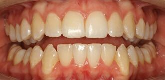 Close-up of teeth after treatment in Phoenix, AZ | 24th Street Dental Biltmore