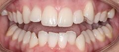 Close-up of teeth before treatment in Phoenix, AZ | 24th Street Dental Biltmore