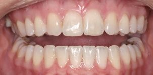 Close-up of teeth after metal braces in Phoenix, AZ | 24th Street Dental Biltmore