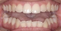 Close-up of teeth after treatment in Phoenix, AZ | 24th Street Dental Biltmore
