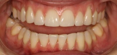 Close-up of teeth after treatment in Phoenix, AZ | 24th Street Dental Biltmore
