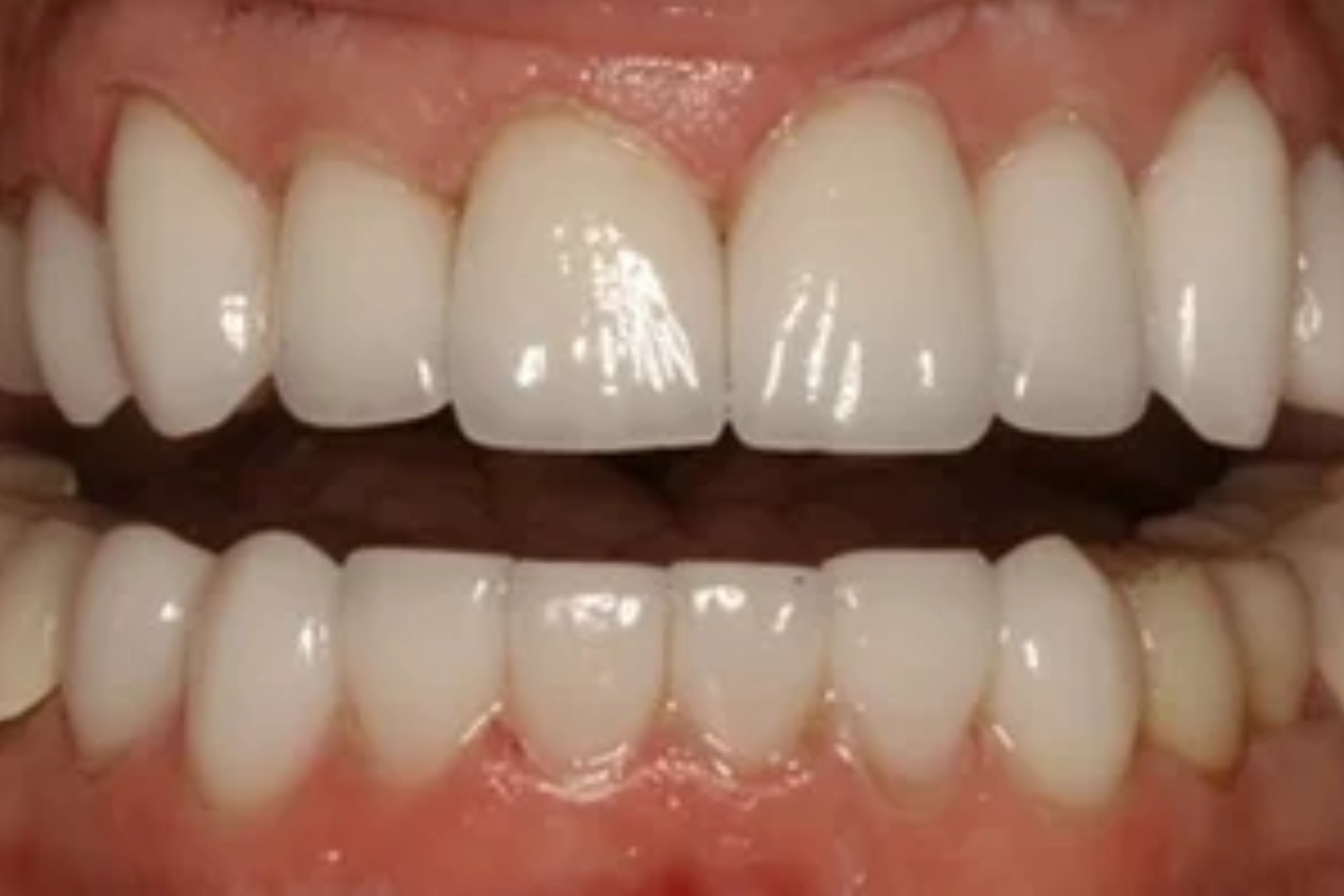Close-up of Teeth After Porcelain Veneers Treatment | 24th Street Dental Biltmore in Phoenix, AZ