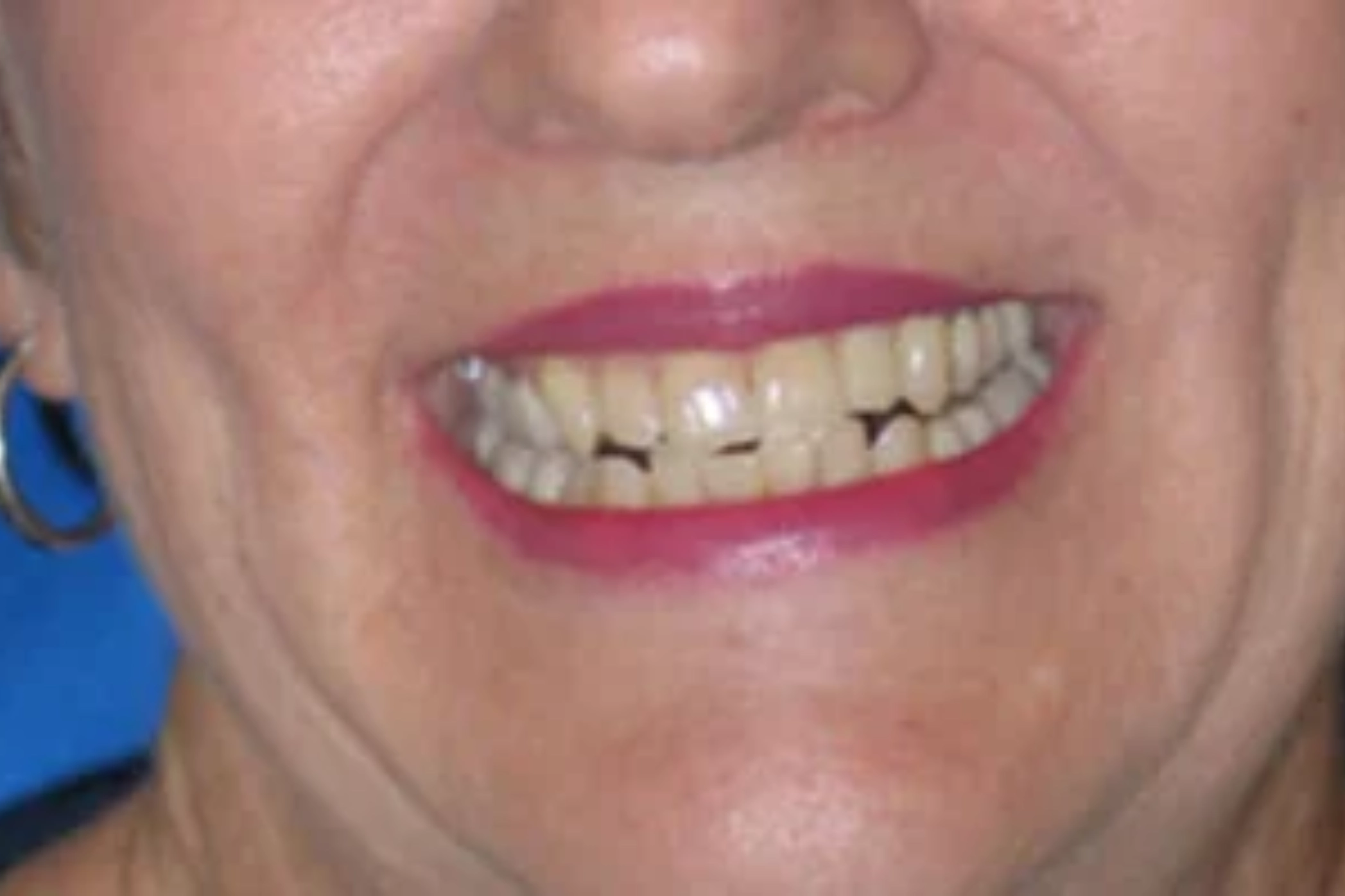 Close-up of woman's smile showing worn and damaged teeth | 24th Street Dental Biltmore in Phoenix, AZ