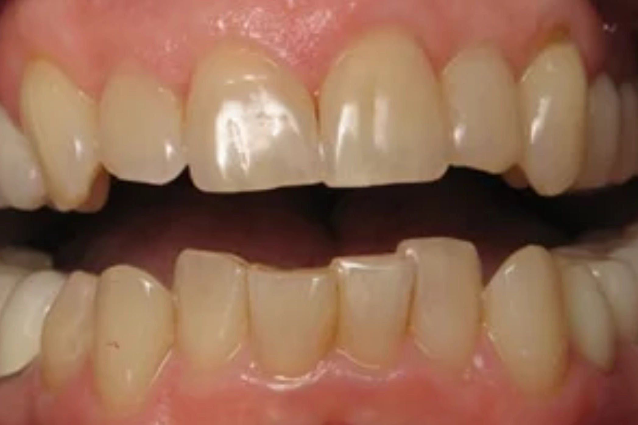 Close-up of Teeth Before Porcelain Veneers Treatment | 24th Street Dental Biltmore in Phoenix, AZ