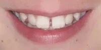 Close-up of teeth dental treatment in Phoenix, AZ | 24th Street Dental Biltmore