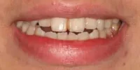 Close-up of teeth before treatment in Phoenix, AZ | 24th Street Dental Biltmore