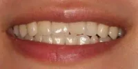 Close-up of teeth before treatment in Phoenix, AZ | 24th Street Dental Biltmore