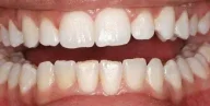 Close-up of teeth after treatment in Phoenix, AZ | 24th Street Dental Biltmore