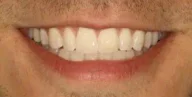 Close-up of teeth after treatment in Phoenix, AZ | 24th Street Dental Biltmore