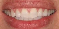 Close-up of teeth after treatment in Phoenix, AZ | 24th Street Dental Biltmore