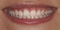 Close-up of teeth after treatment in Phoenix, AZ | 24th Street Dental Biltmore