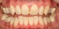 Close-up of teeth before Treatment in Phoenix, AZ | 24th Street Dental Biltmore