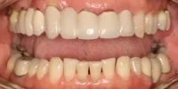 Close-up of teeth dental treatment in Phoenix, AZ | 24th Street Dental Biltmore