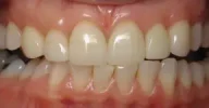 Close-up of yellowed, misaligned teeth in Phoenix, AZ | 24th Street Dental Biltmore