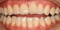 Close-up of teeth before treatment in Phoenix, AZ | 24th Street Dental Biltmore