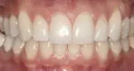 Close-up of teeth before treatment in Phoenix, AZ | 24th Street Dental Biltmore