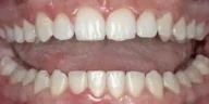 Close-up of teeth dental treatment in Phoenix, AZ | 24th Street Dental Biltmore