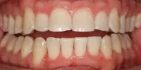 Close-up of teeth after treatment in Phoenix, AZ | 24th Street Dental Biltmore