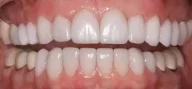 Close-up of teeth after treatment in Phoenix, AZ | 24th Street Dental Biltmore
