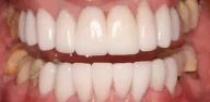 Close-up of teeth dental treatment in Phoenix, AZ | 24th Street Dental Biltmore