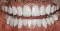 Teeth after orthodontic alignment in Phoenix, AZ | 24th Street Dental Biltmore