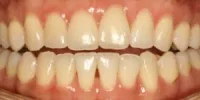 Close-up of teeth after treatment in Phoenix, AZ | 24th Street Dental Biltmore
