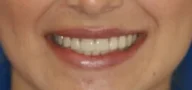 Close-up of teeth after treatment in Phoenix, AZ | 24th Street Dental Biltmore