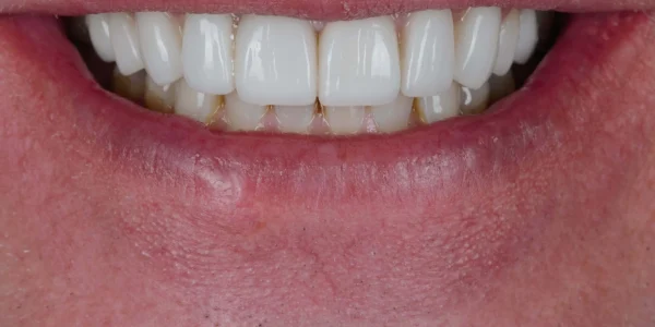Close-up of teeth after treatment in Phoenix, AZ | 24th Street Dental Biltmore