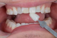 Tooth shade match crown in Phoenix, AZ | 24th Street Dental Biltmore