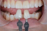 Tooth shade match crown in Phoenix, AZ | 24th Street Dental Biltmore