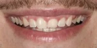 Close-up of teeth after treatment in Phoenix, AZ | 24th Street Dental Biltmore