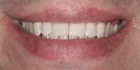 Close-up of teeth after treatment in Phoenix, AZ | 24th Street Dental Biltmore