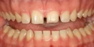 Close-up of teeth before treatment in Phoenix, AZ | 24th Street Dental Biltmore