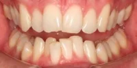Close-up of teeth before treatment in Phoenix, AZ | 24th Street Dental Biltmore