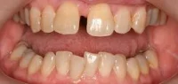 Close-up of teeth before treatment in Phoenix, AZ | 24th Street Dental Biltmore
