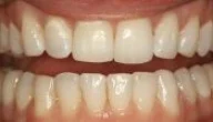Close-up of teeth dental treatment in Phoenix, AZ | 24th Street Dental Biltmore