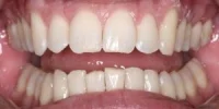 Close-up of teeth after treatment in Phoenix, AZ | 24th Street Dental Biltmore