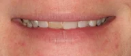 Close-up of teeth before treatment in Phoenix, AZ | 24th Street Dental Biltmore
