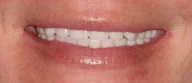 Close-up of teeth after treatment in Phoenix, AZ | 24th Street Dental Biltmore