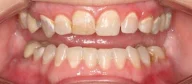 Close-up of teeth before treatment in Phoenix, AZ | 24th Street Dental Biltmore